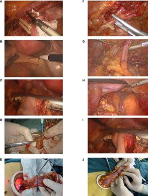 Novel surgical procedure for preventing anastomotic leakage following colorectal cancer surgery: A propensity score matching study